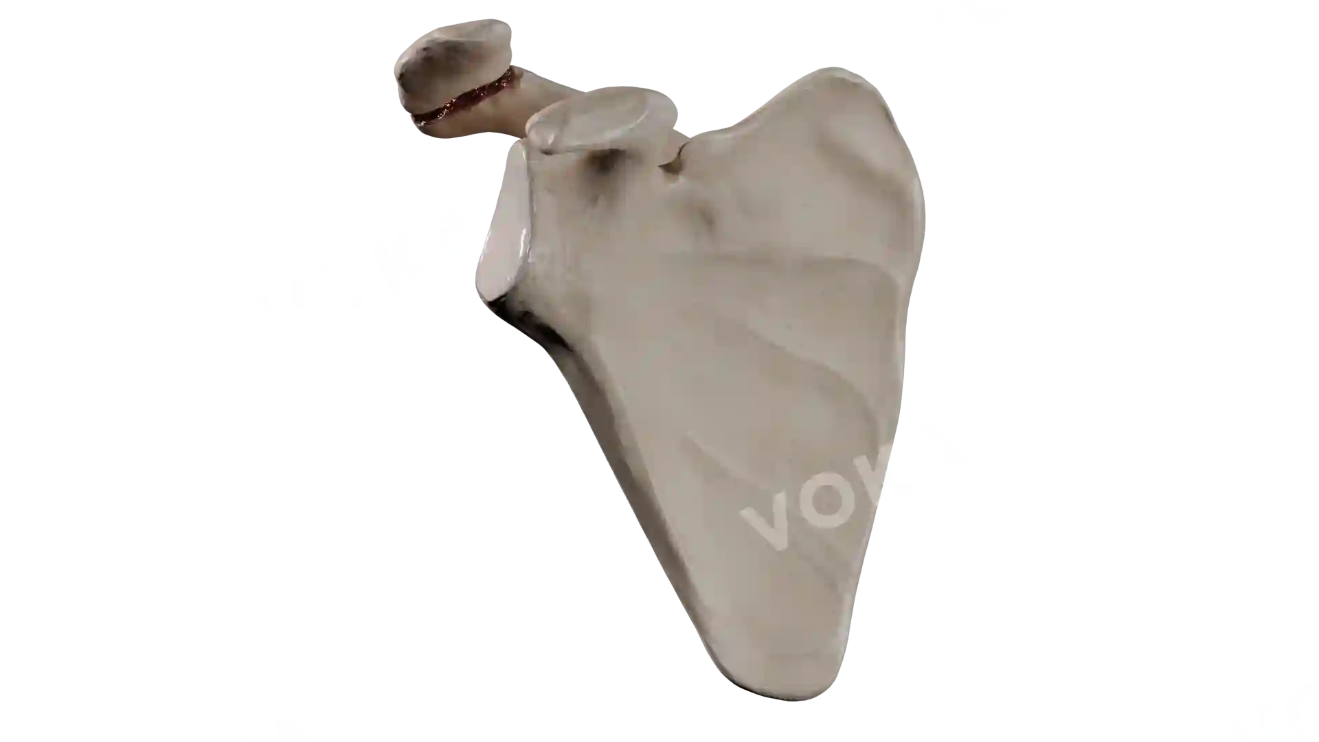 Scapula fraction type 3 HA4 1 trv image