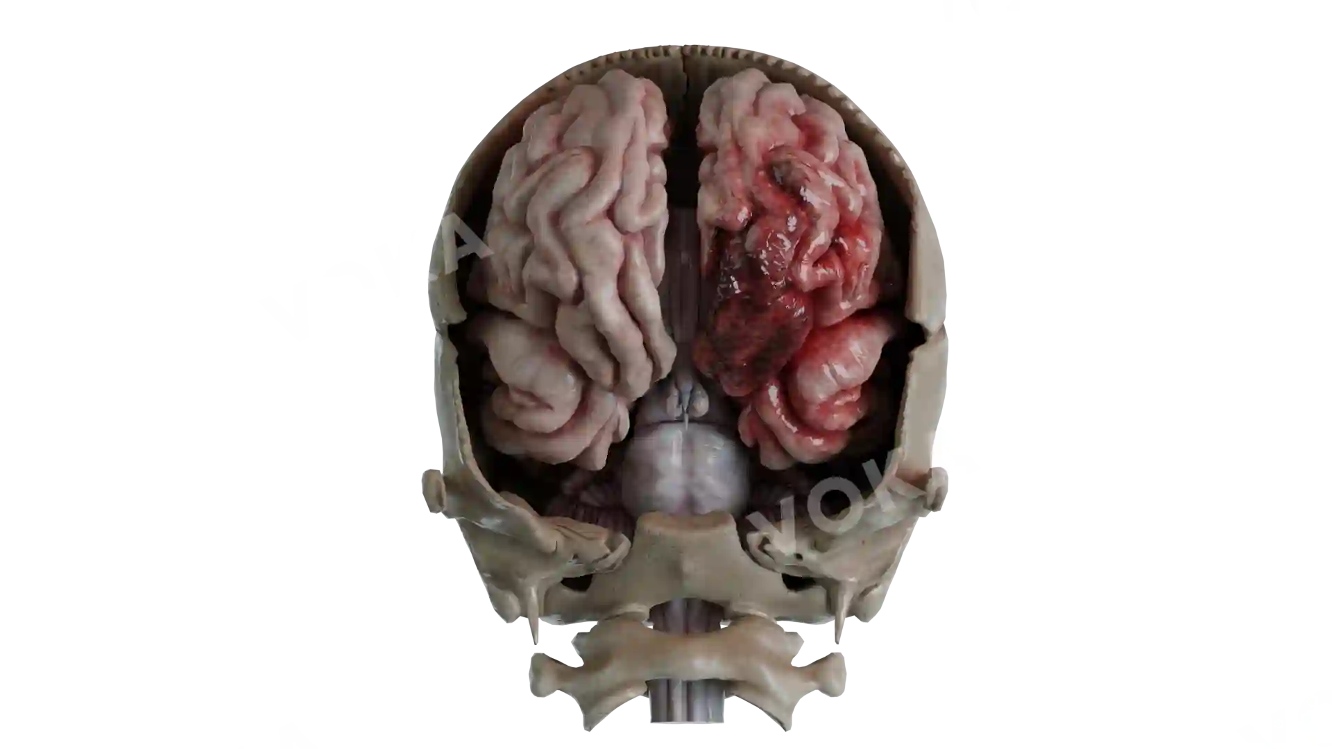 Cerebral contusions image