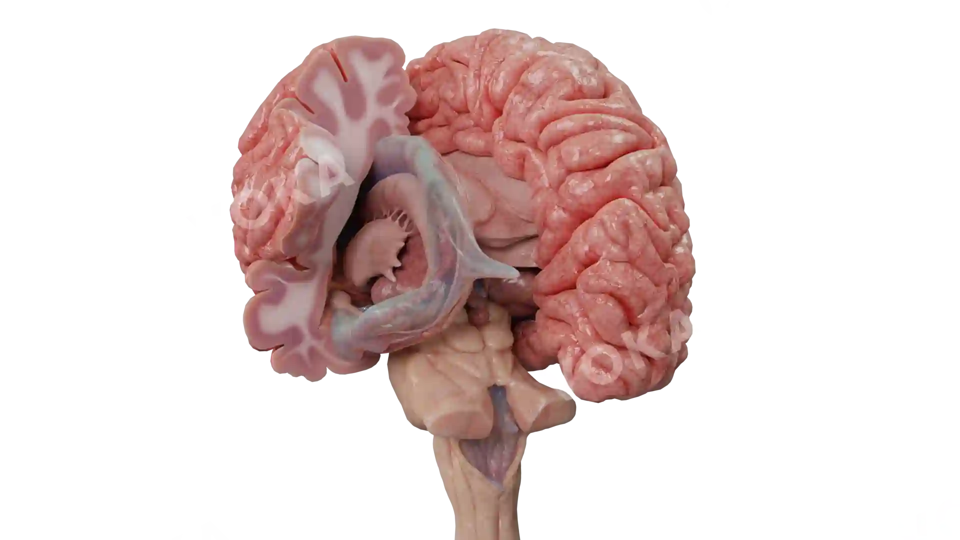 Cerebrum tumor 1 image