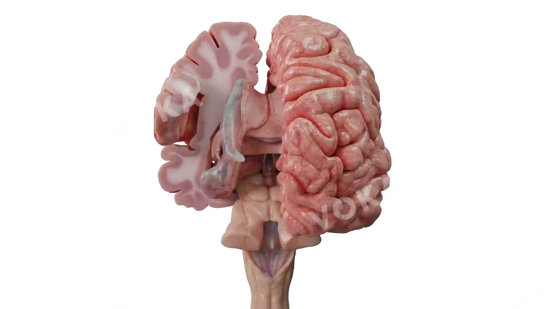 Cerebrum tumor 2 image
