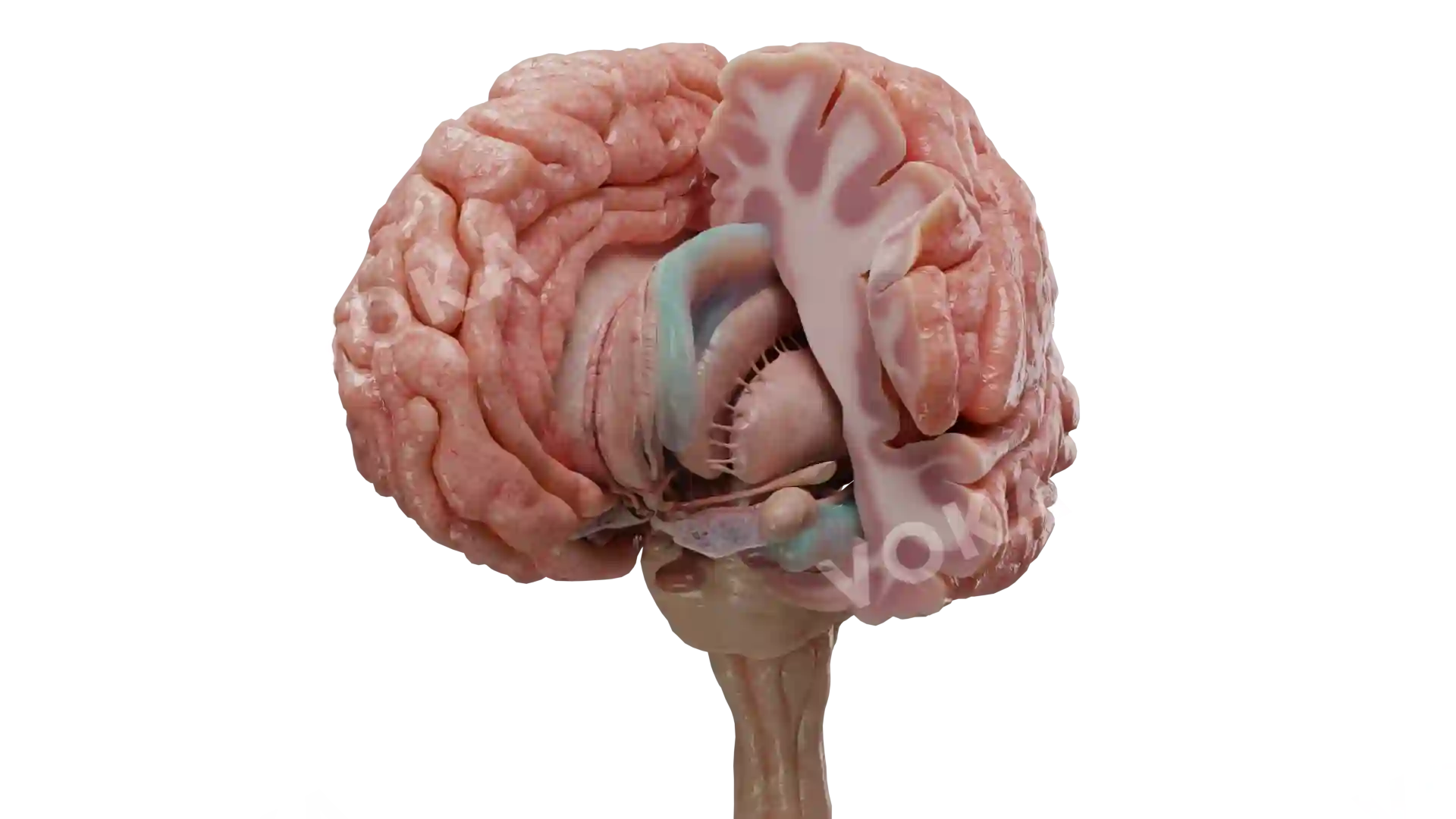 Cerebrum tumor 3 image