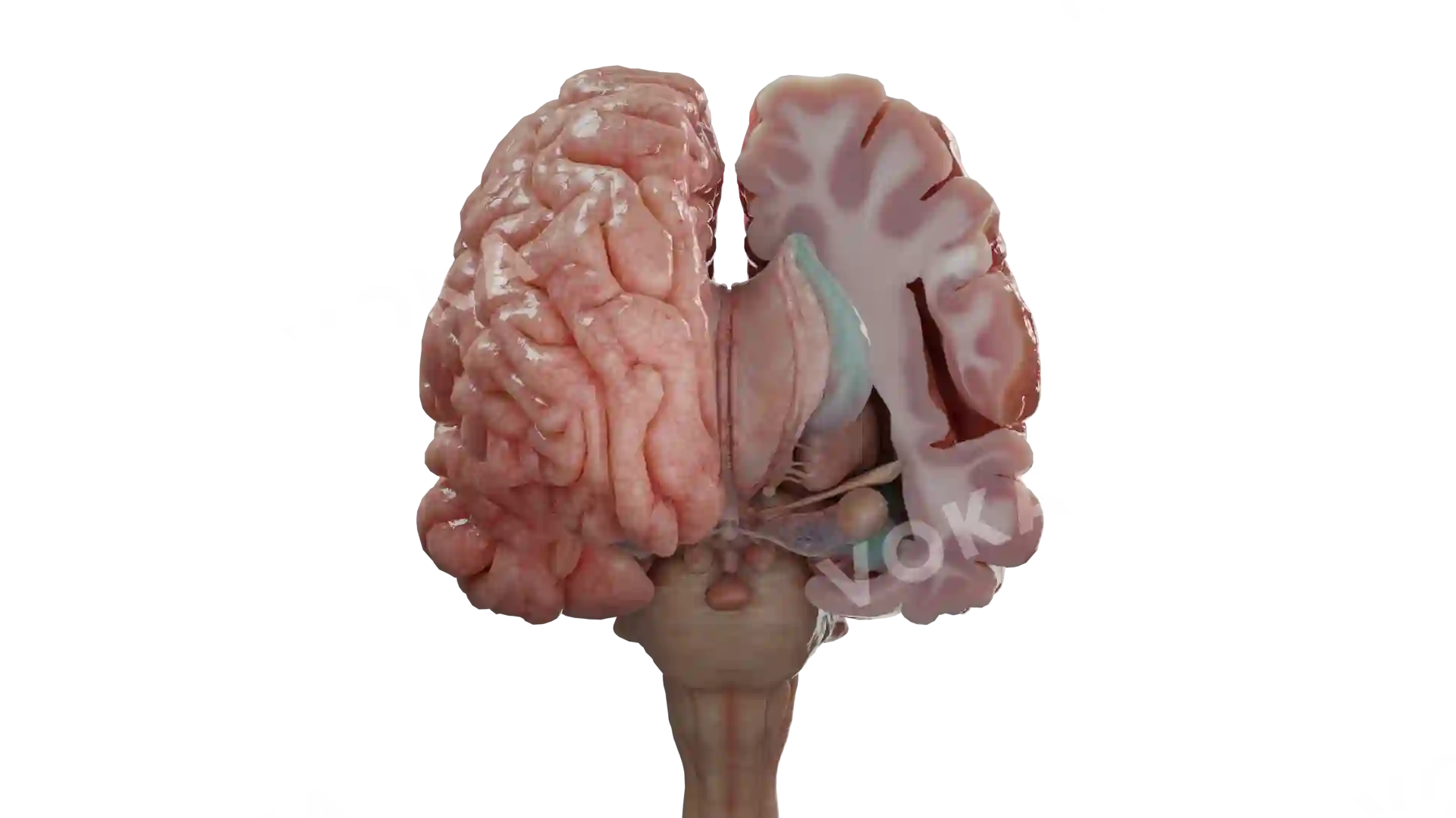 Cerebrum tumor 4 image