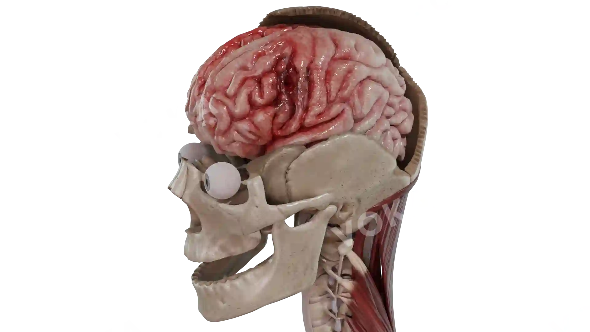 Gunshot wounds of skull and brain image