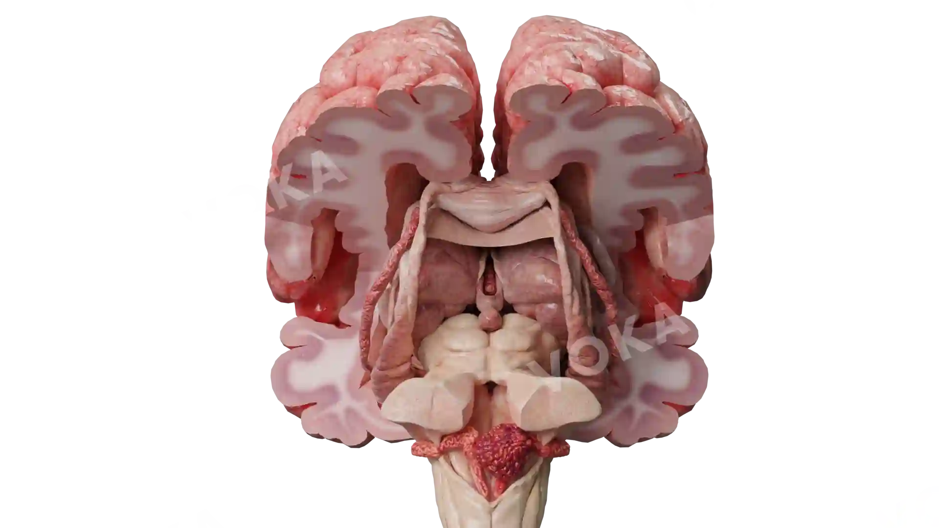 Papiloma plexus choroideus 2 image