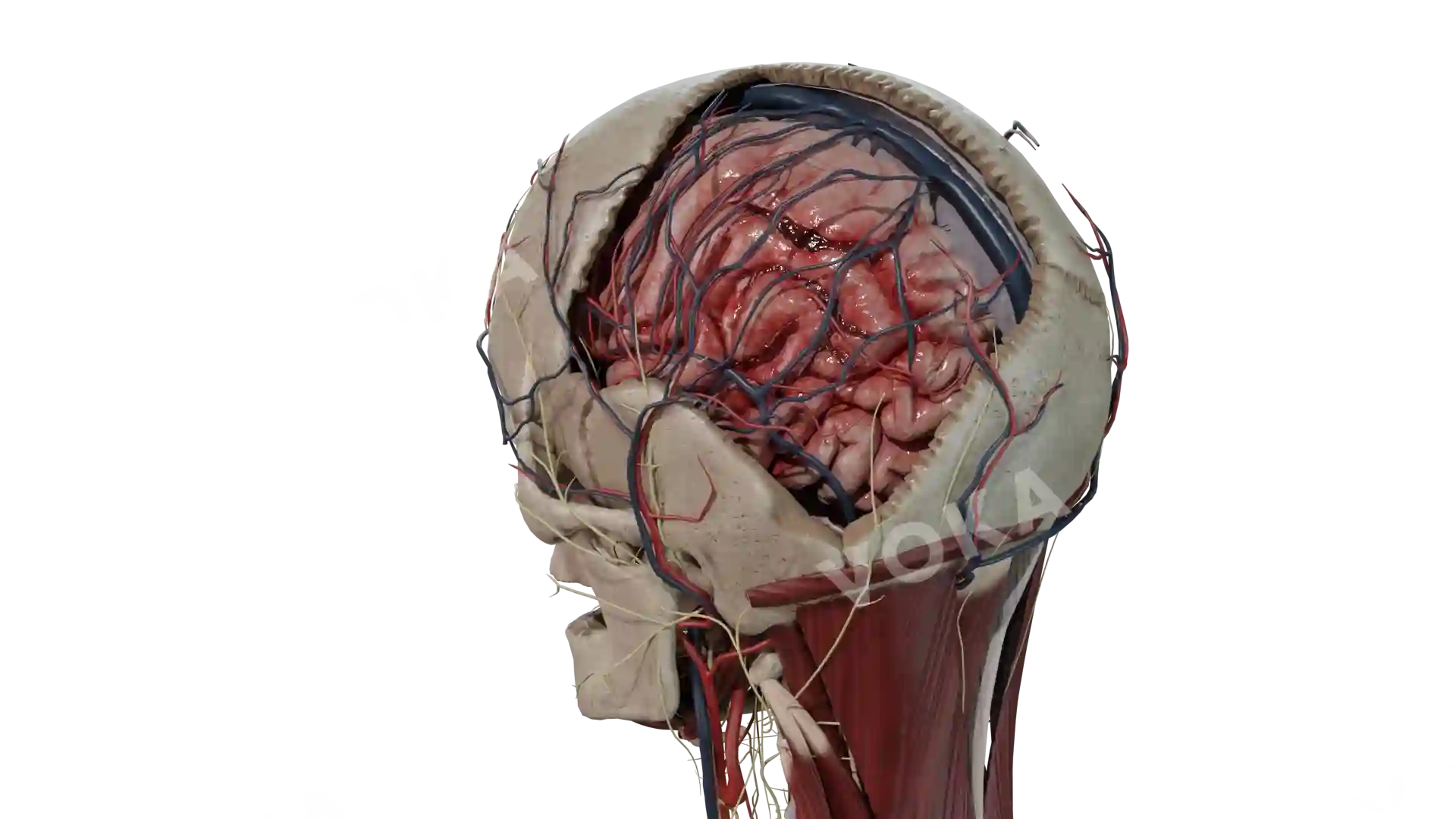 Traumatic subarachnoid hemorrhage and intraventricular hemorrhage image