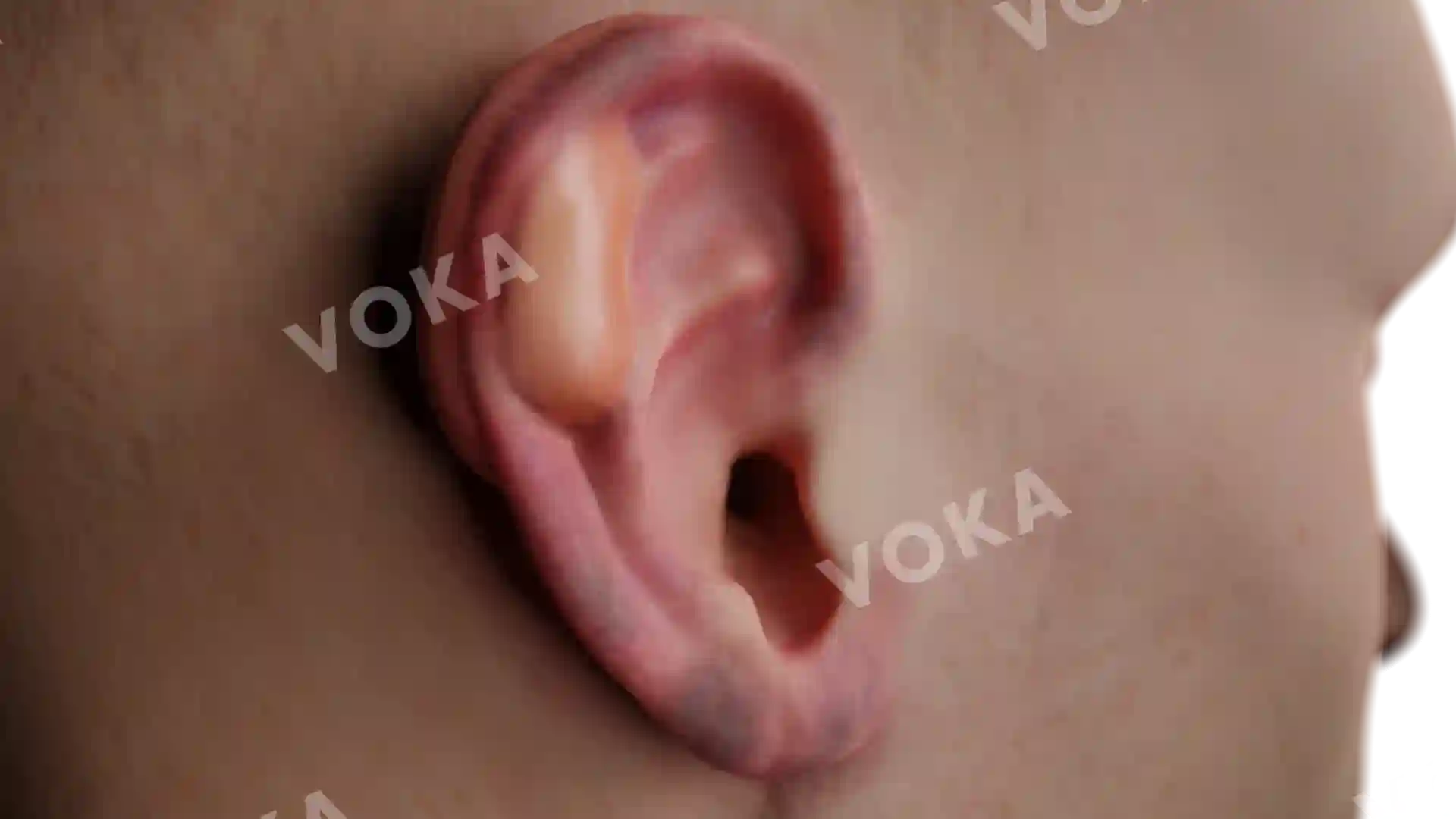 2nd degree auricular burn image