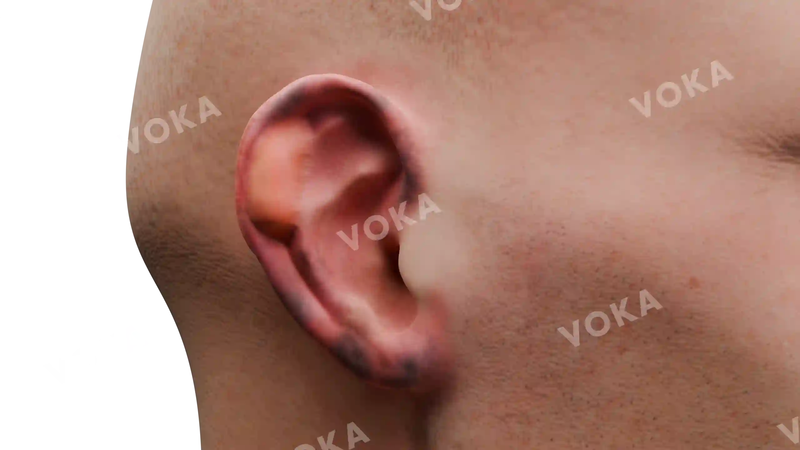 3rd degree frostbite of the auricle image