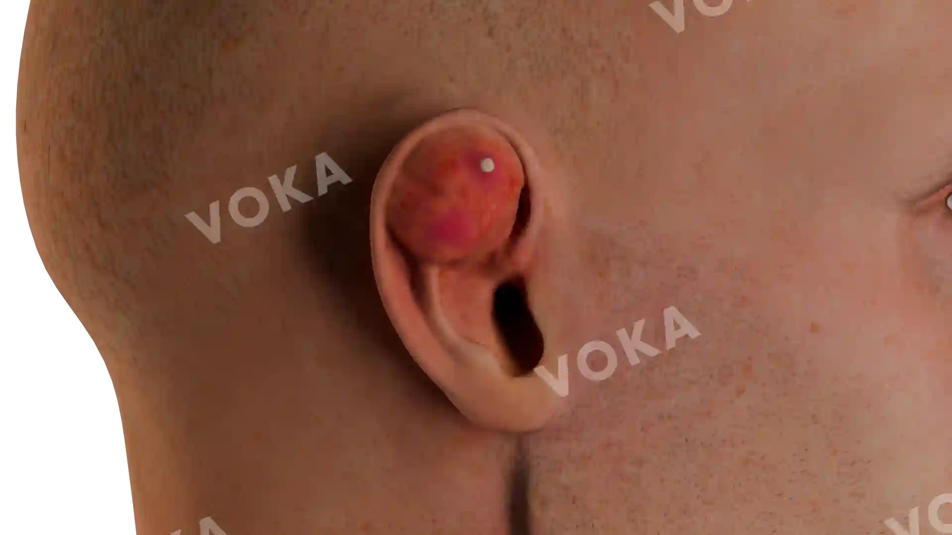 Abscess of the right auricle image