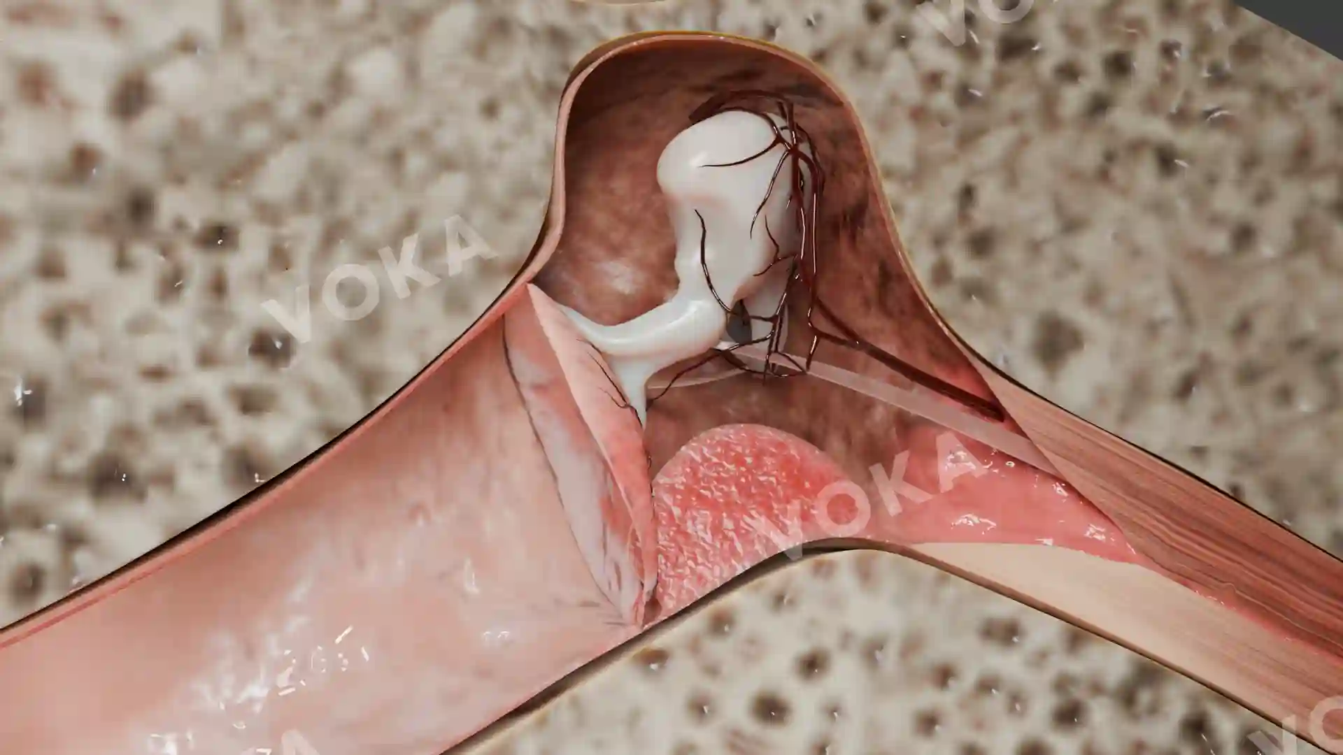 Epitympanitis with polyp image