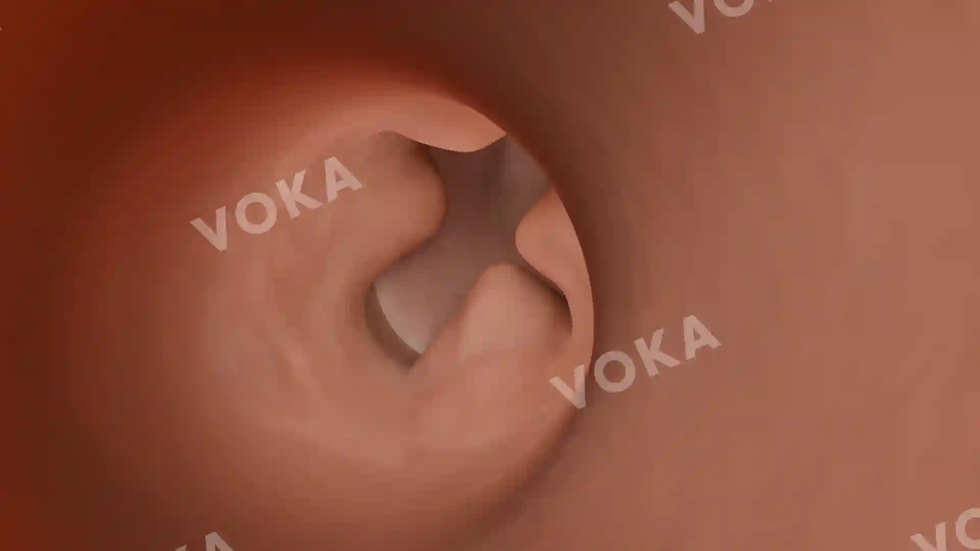 Exostoses of the auditory canal image