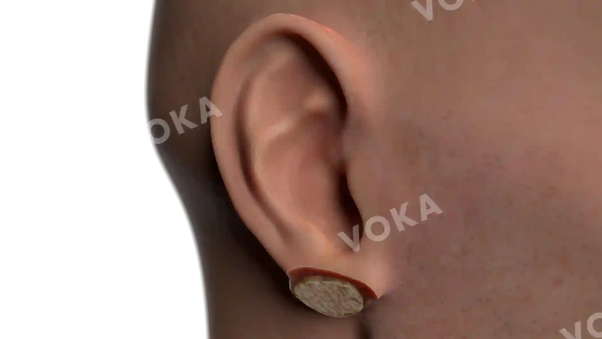 Festering atheroma of the earlobe in section image