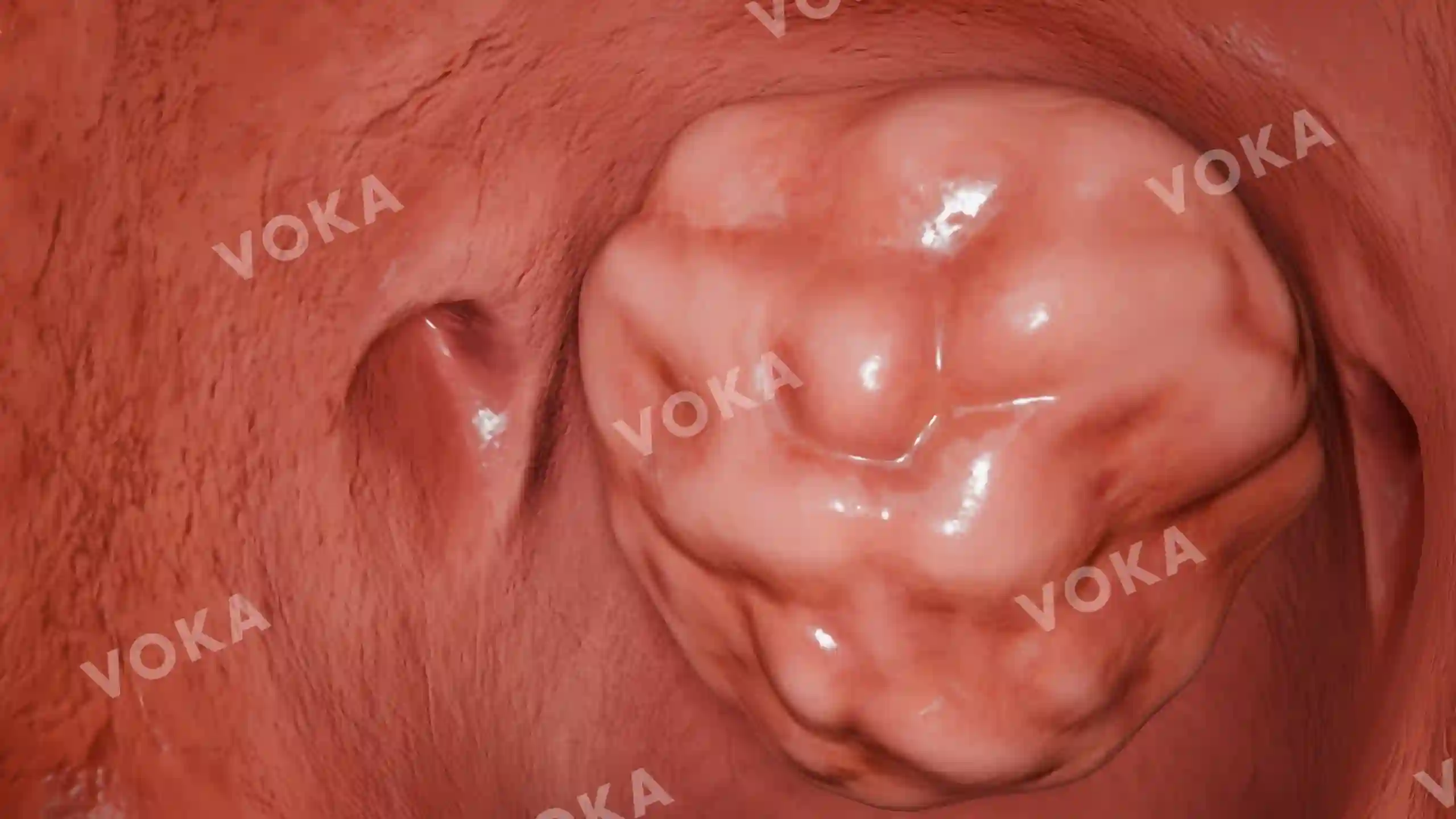Location of adenoids in relation to the aperture of the auditory tube image