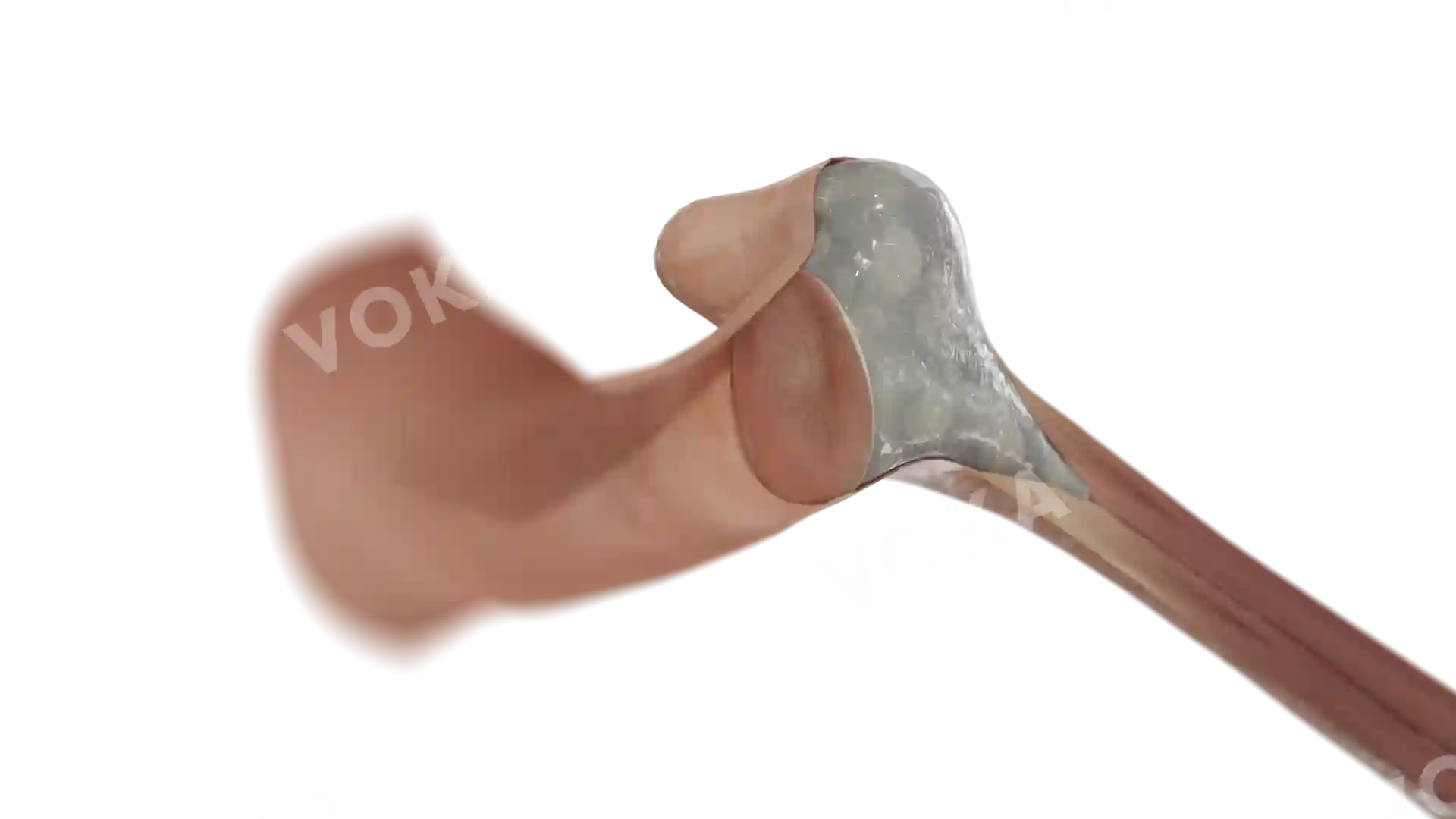 Otitis media with effusion image