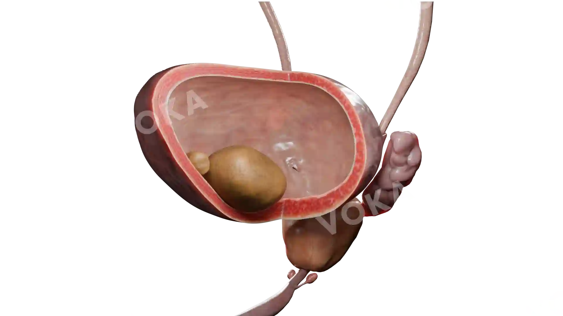 Bladder calculus image