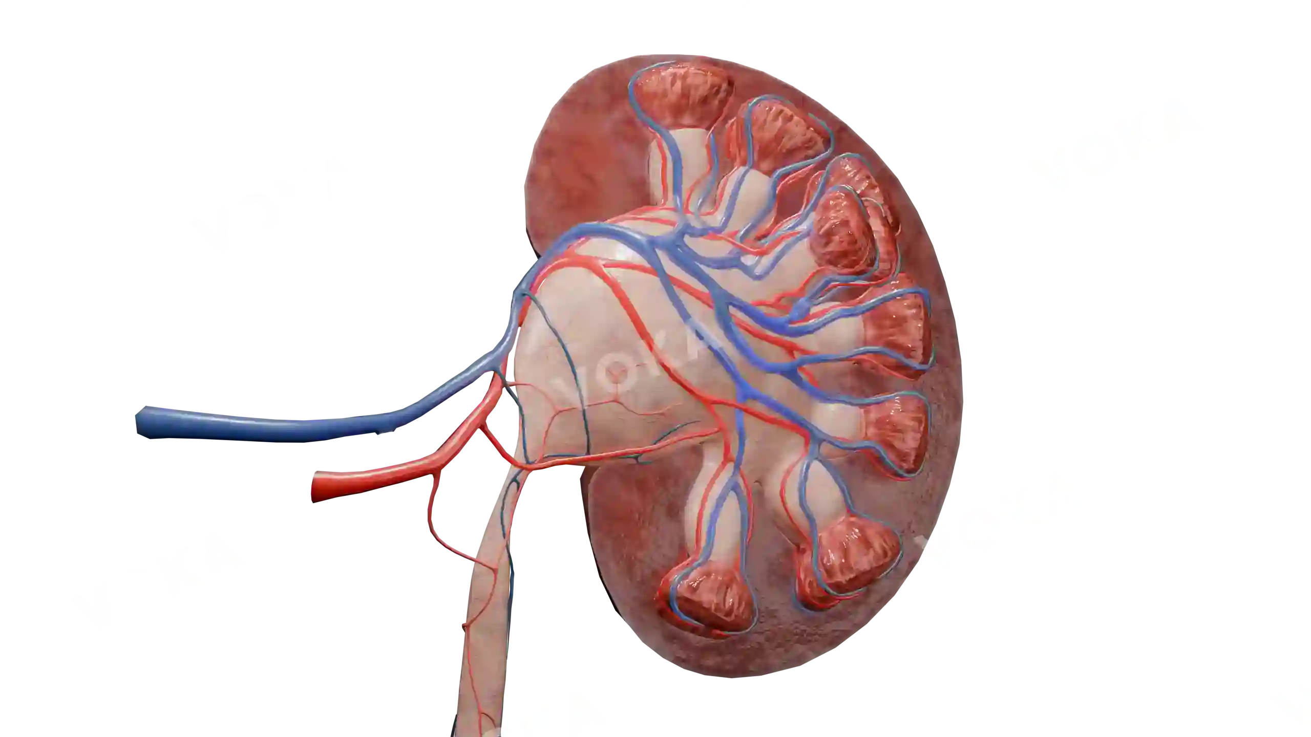 Hydronephrosis with obstruction image
