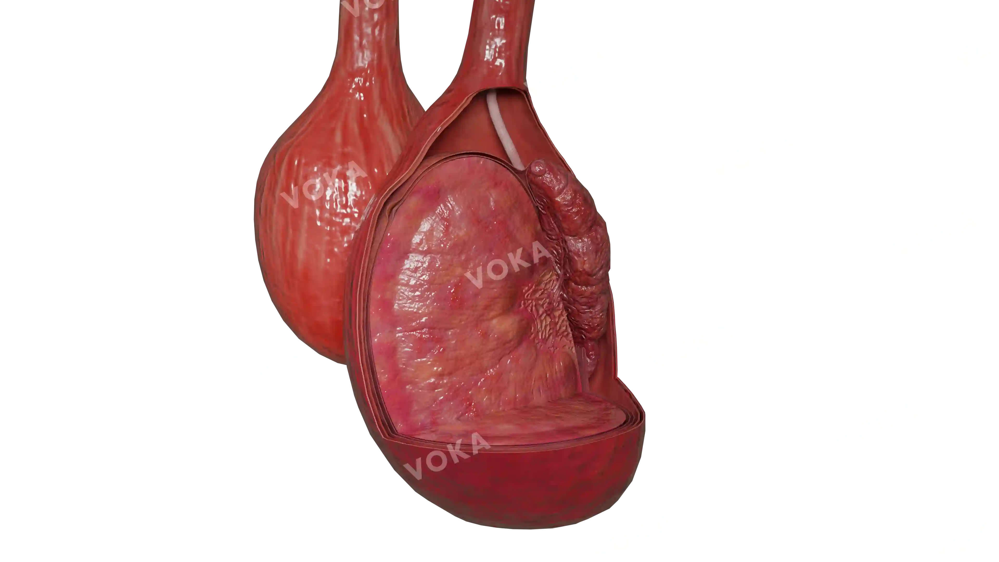 Orchyoepididymitis image