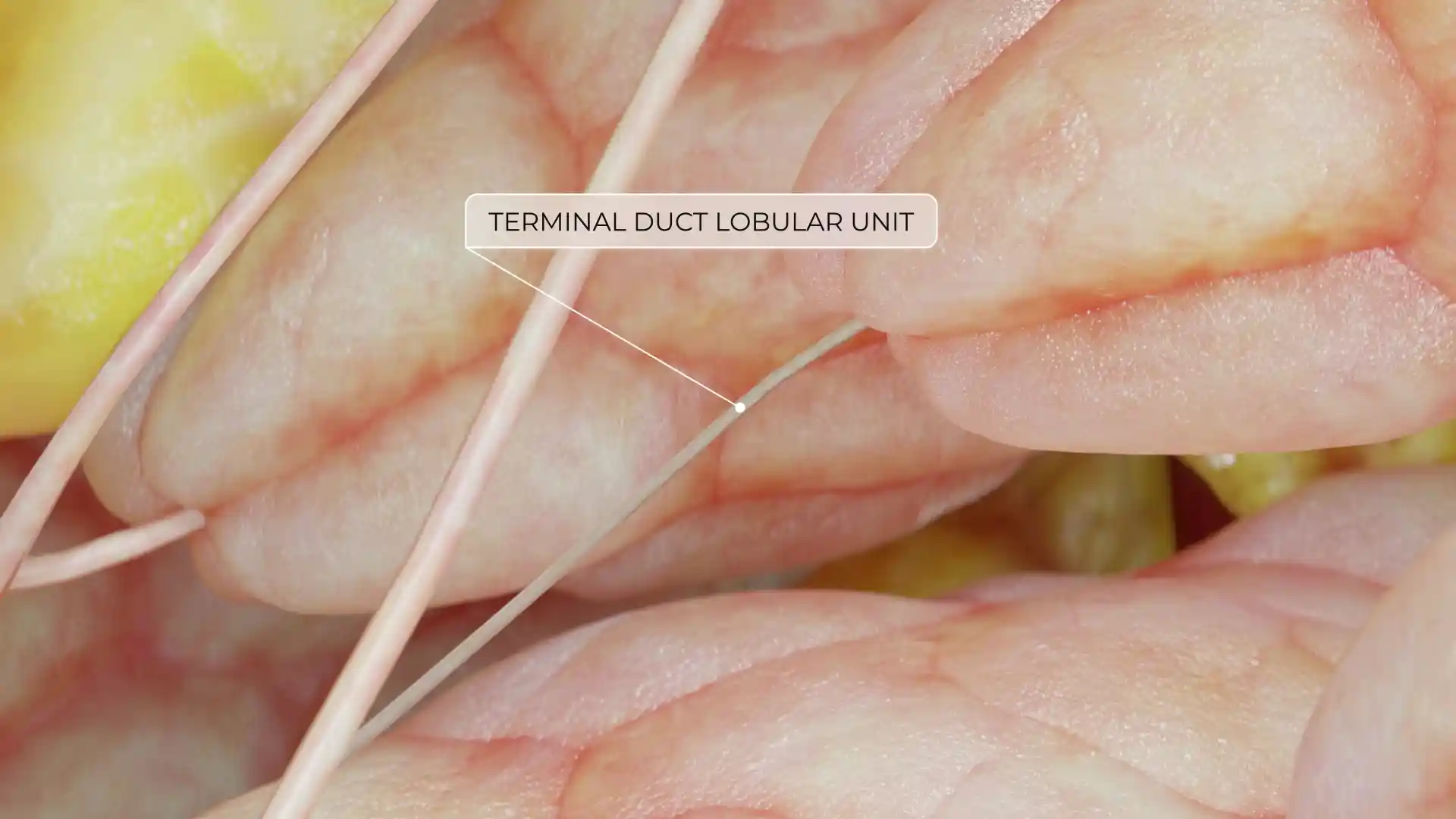 Breast cyst animation