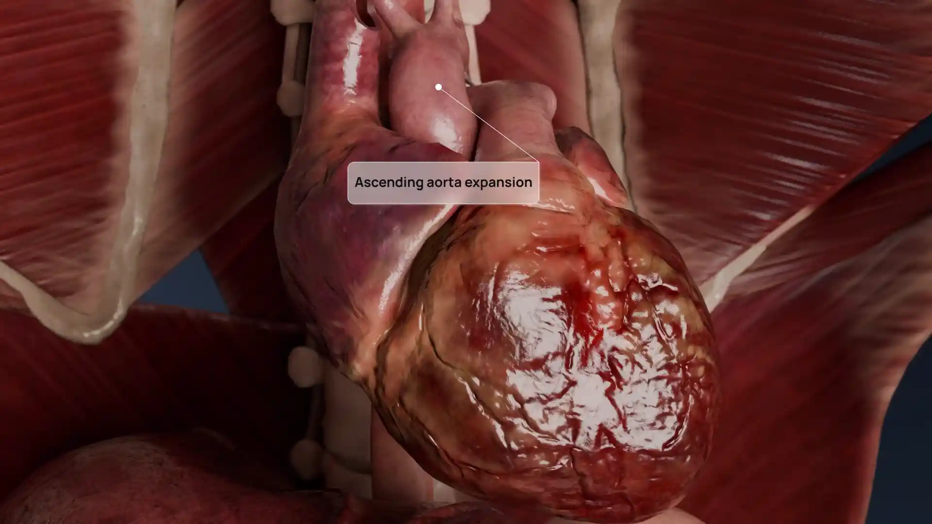 Aortic valve dilatation animation