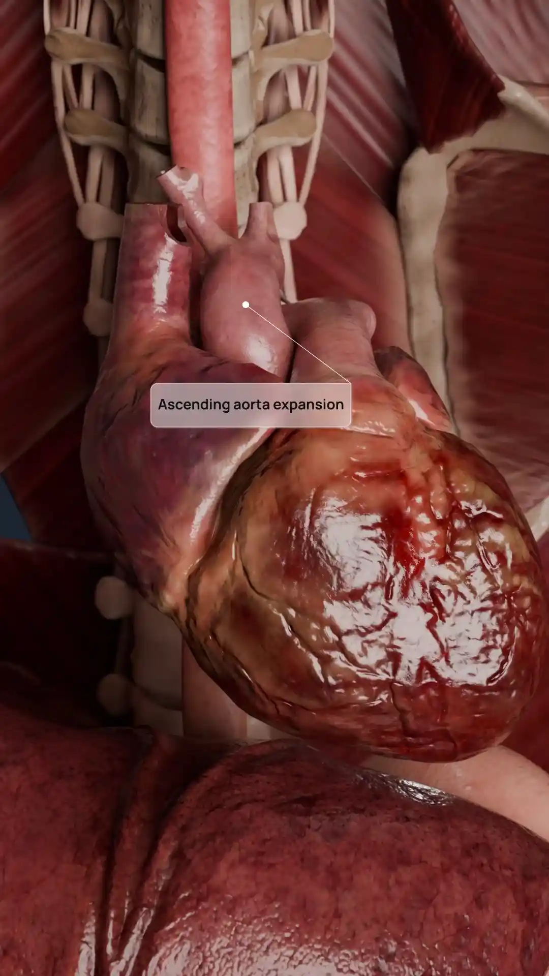 Aortic valve dilatation animation