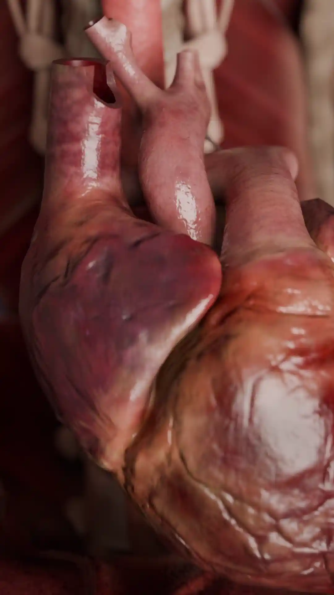 Aortic valve stenosis rheumatic animation