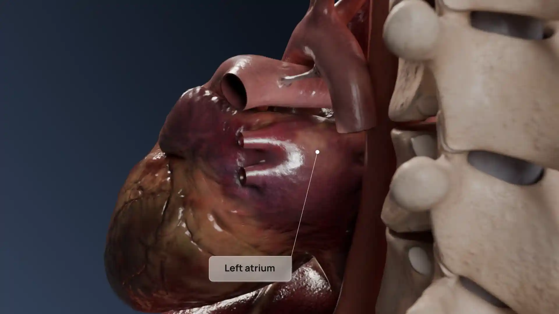 Infective endocarditis of the left heart animation
