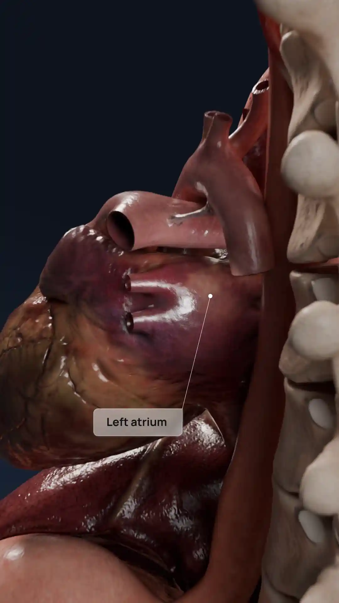Infective endocarditis of the left heart animation