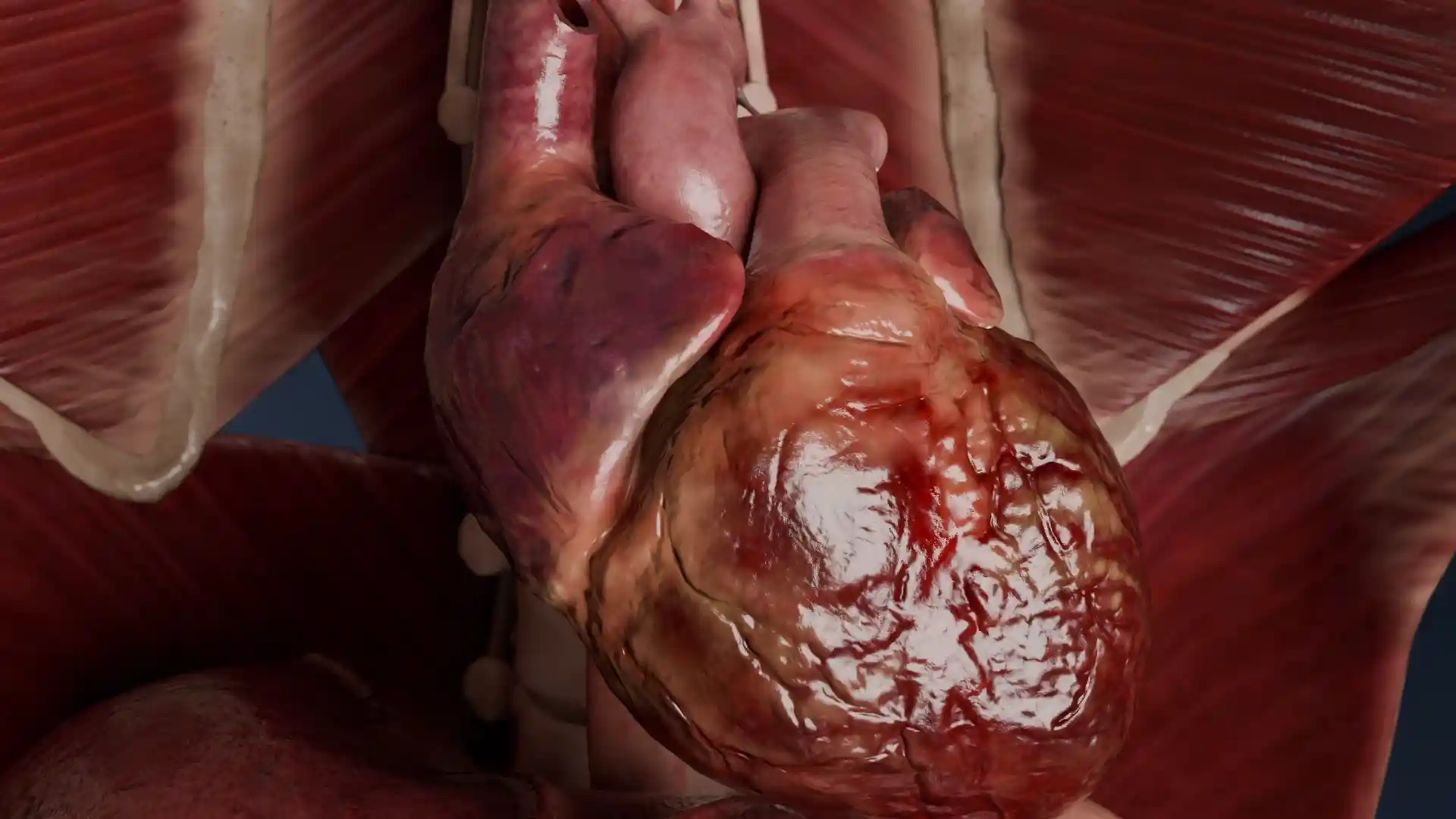 Redundancy of aortic valve leaflets animation