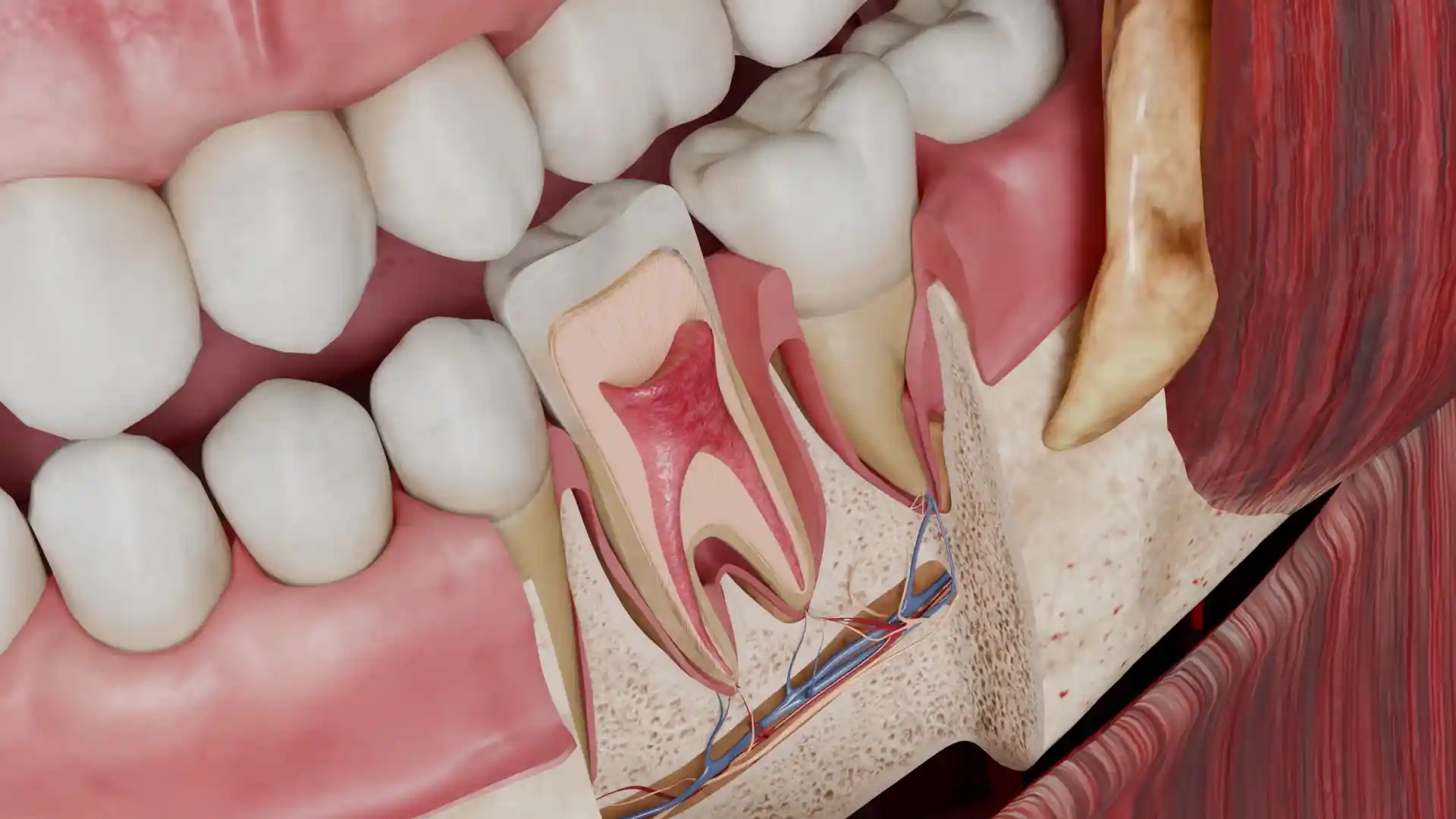 Chronic apical abscess animation
