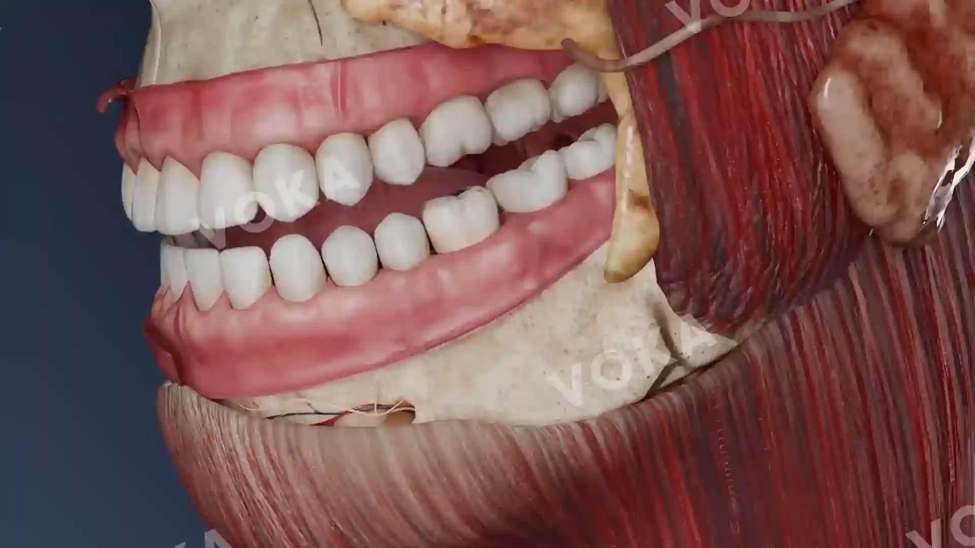 Periapical cyst animation