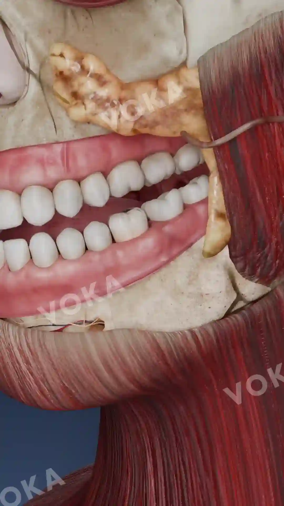 Periapical cyst animation