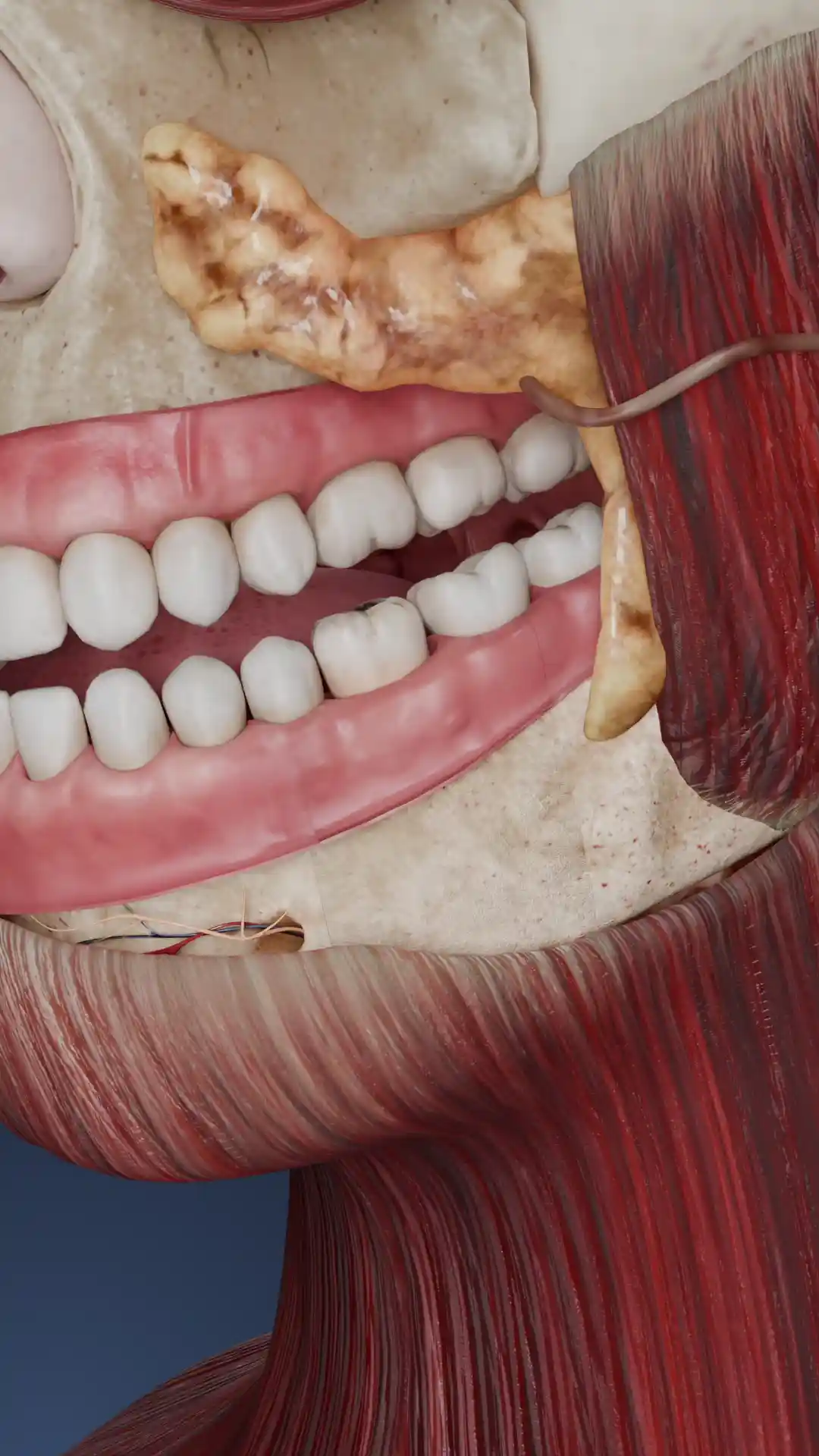 Pocket cyst animation