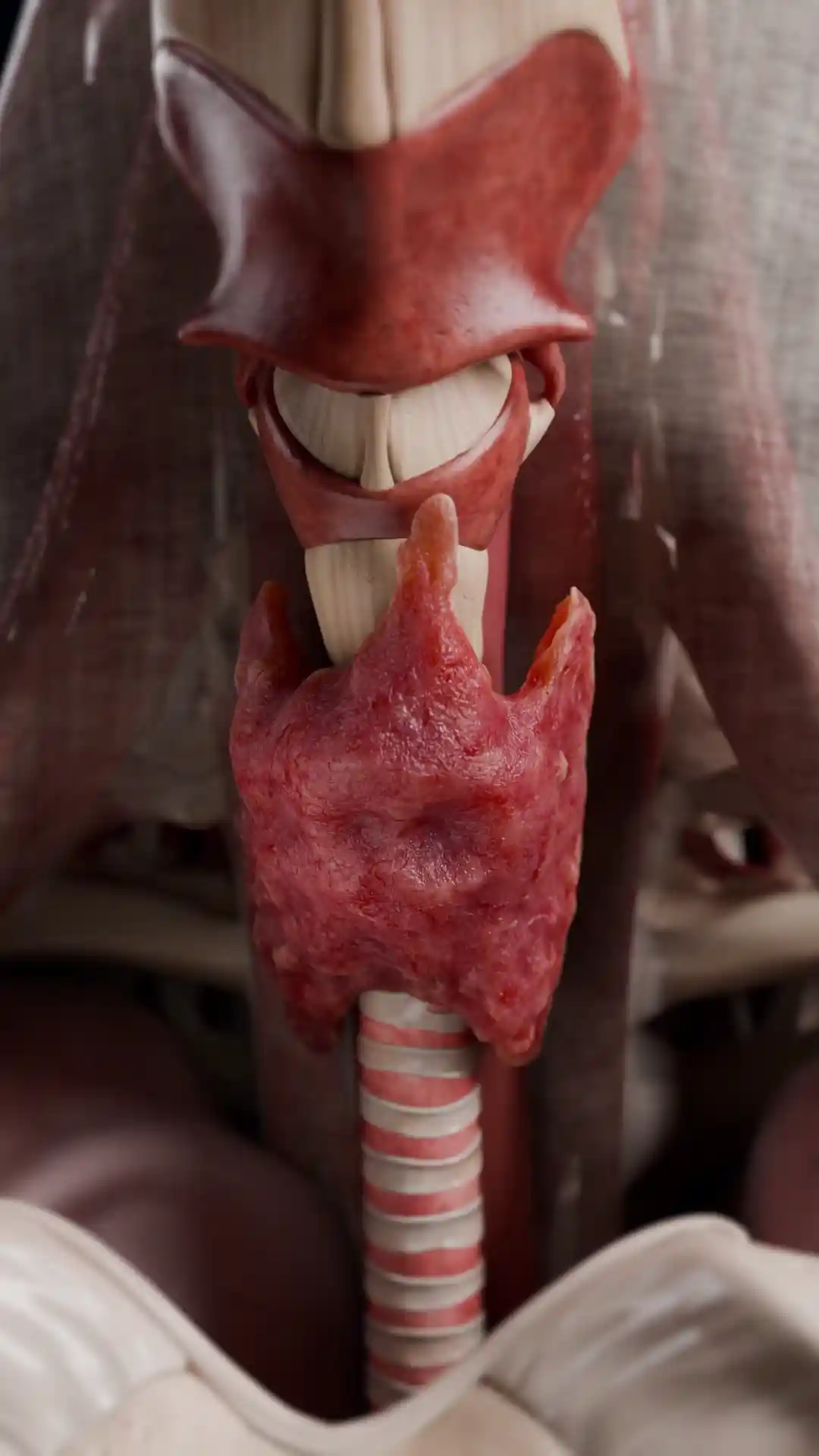 Diffuse goiter of the thyroid gland animation