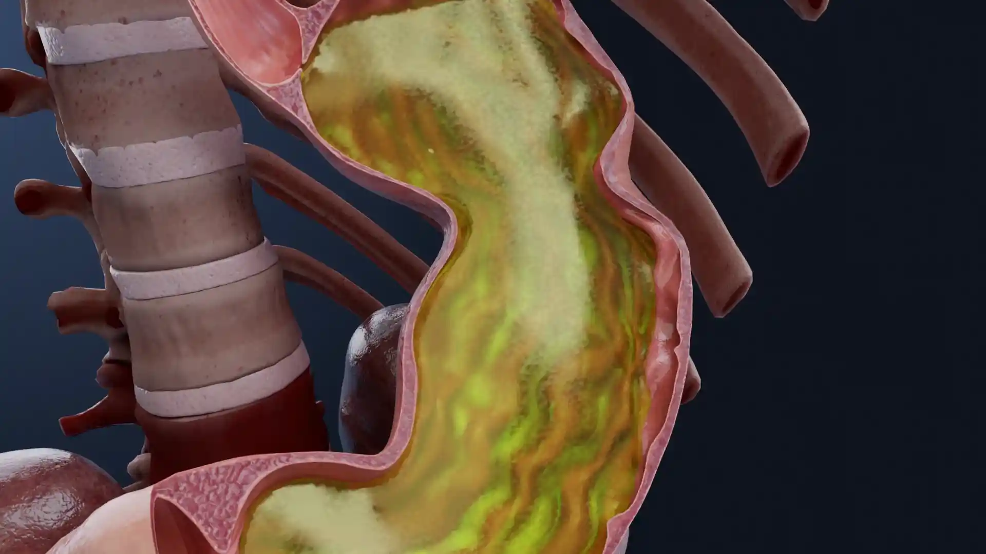 Gastroesophageal reflux animation