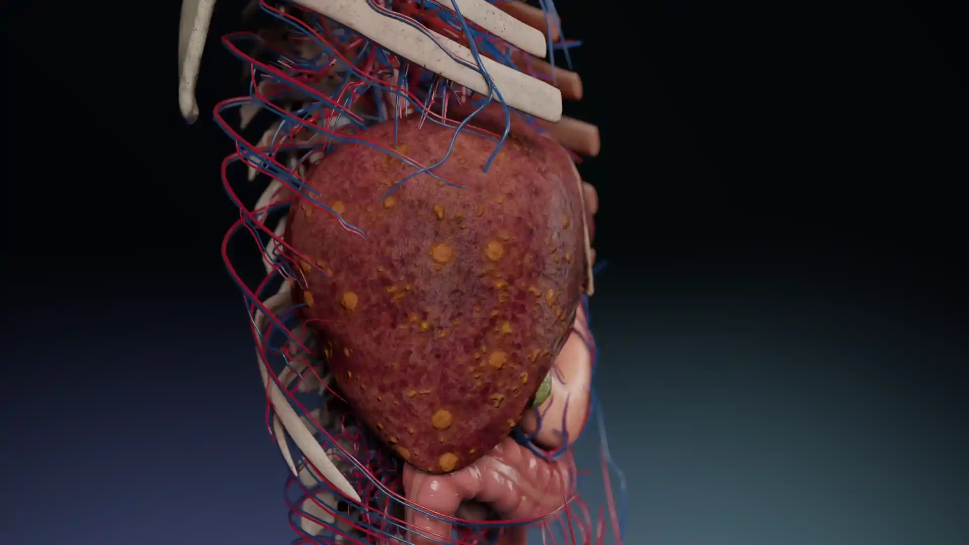 Cirrhosis animation
