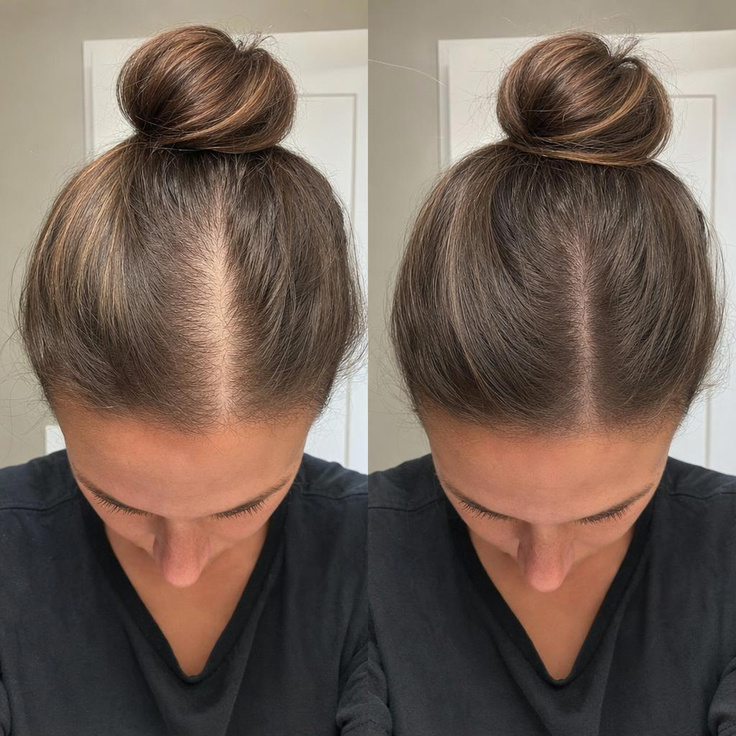 Rhonda's fuller hairline after two weeks
