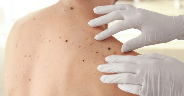 ¡Atención! El melanoma maligno es el tercer cáncer más común en Perú