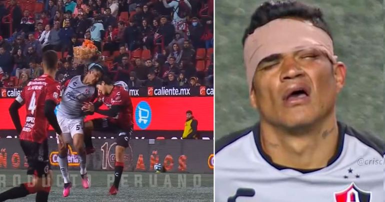 Liga Mexicana: Anderson Santamaría sufrió una dura lesión en el rostro