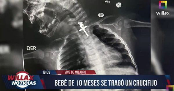 Trujillo: personal médico salvó la vida a una bebé de 10 meses que se tragó un crucifijo