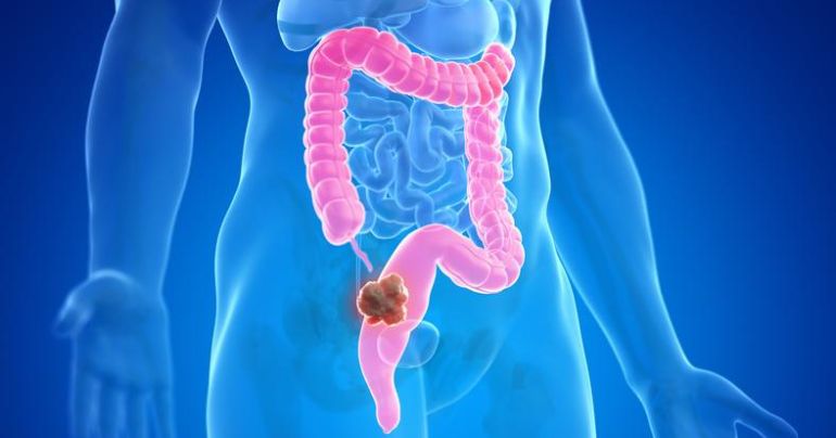 Portada: Cáncer de colon: conozca el innovador test para detección de la enfermedad con alta efectividad