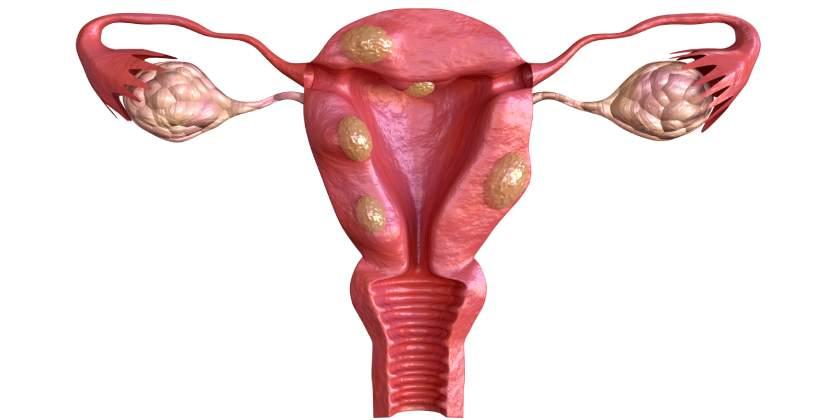 Conozca más sobre la miomatosis uterina y su tratamiento