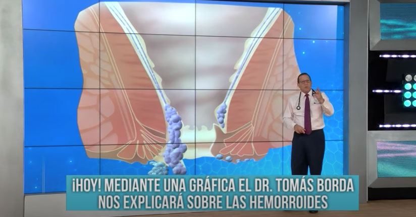 Dr. Borda: "Levantar peso con regularidad genera que las hemorroides sean patológicas"