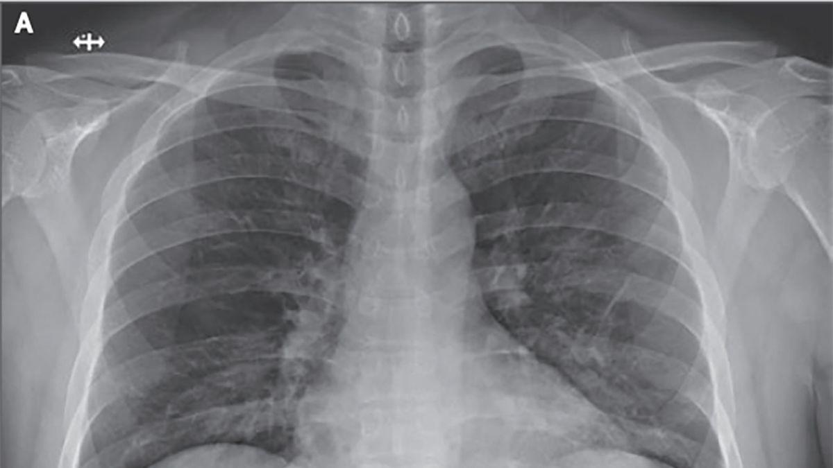 En solo cuatro días el Covid-19 puede dañar severamente los pulmones