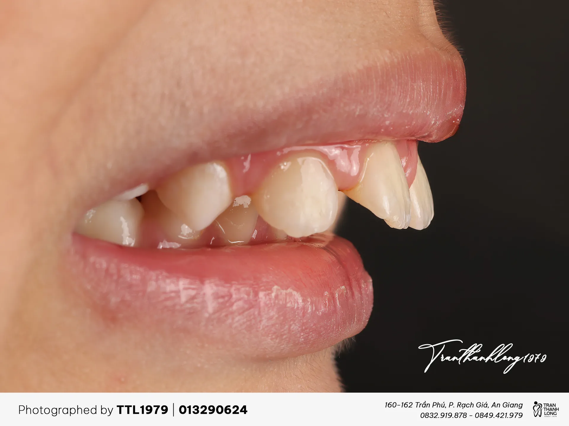 Kết quả điều trị của 013290624 - Before