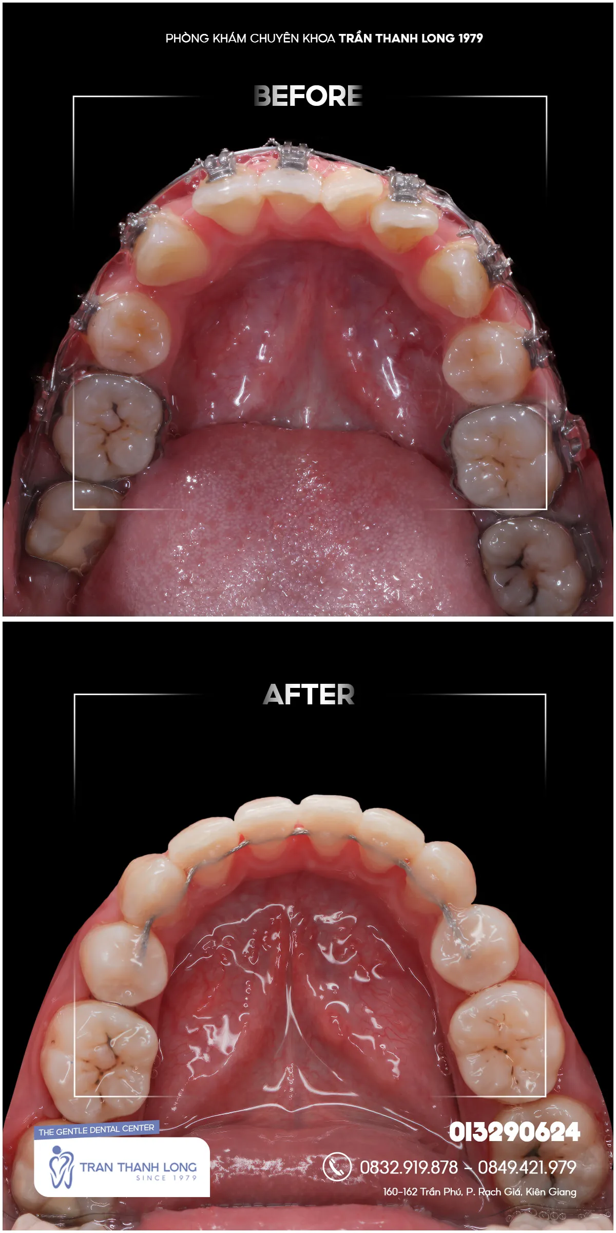 Hình ảnh quá trình điều trị 3