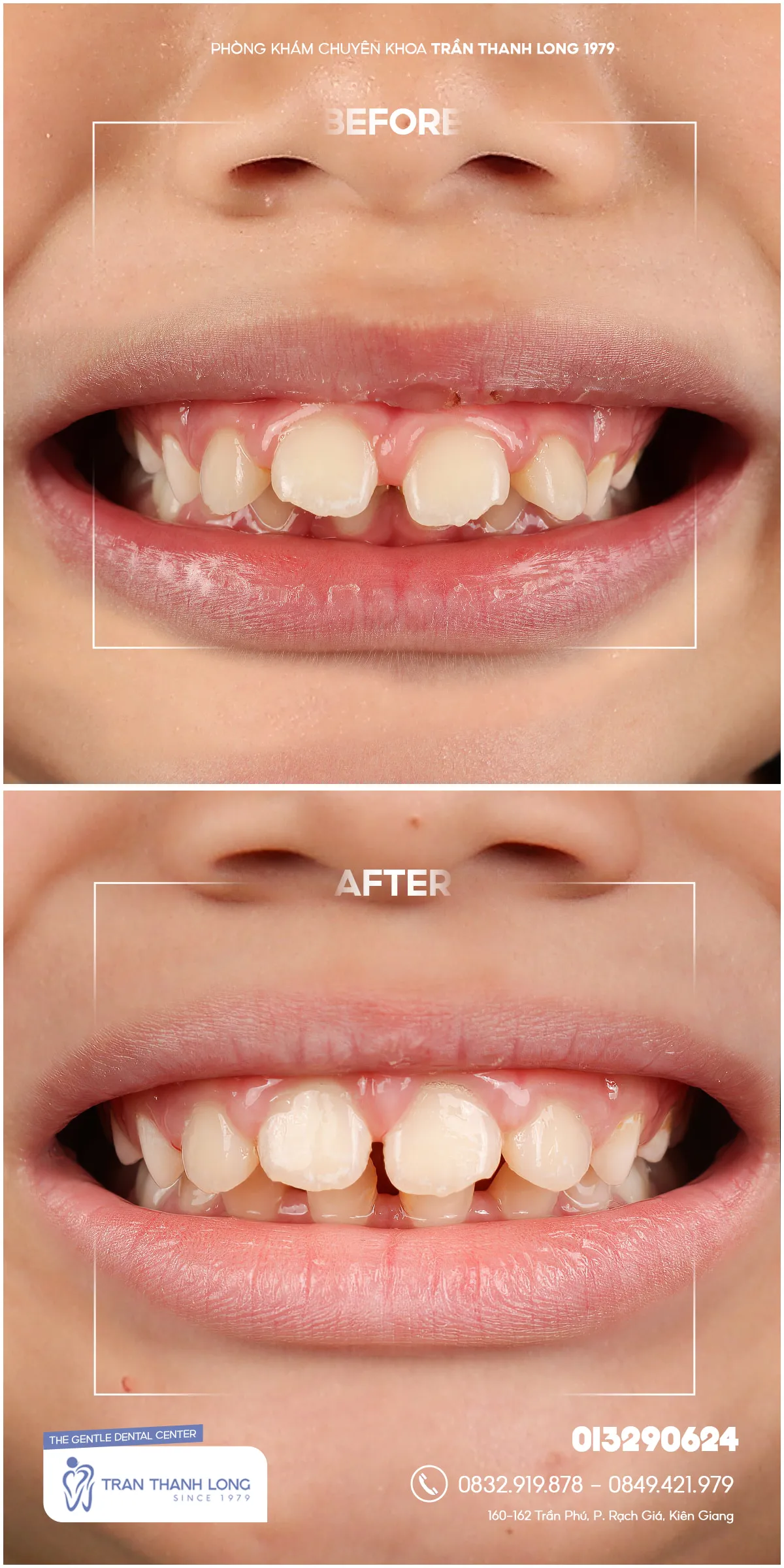 Hình ảnh quá trình điều trị 3