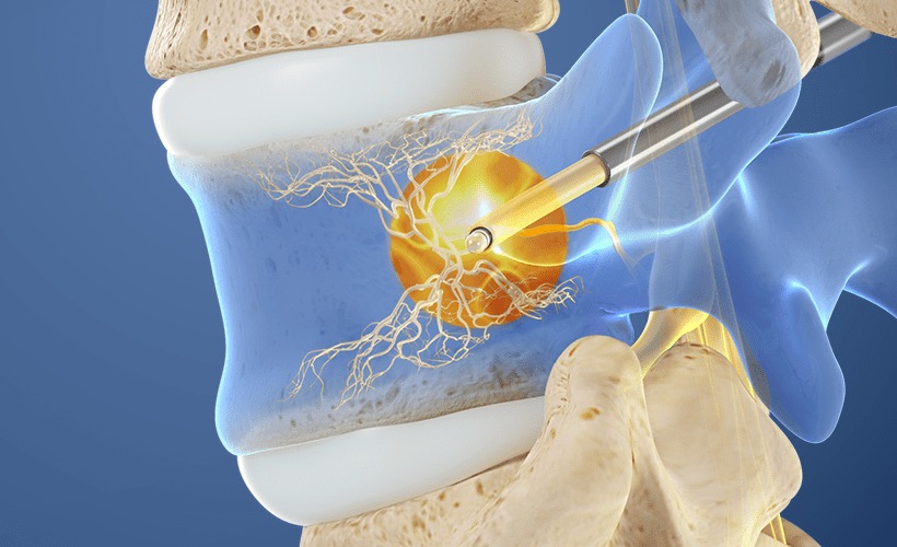 The Intracept® Procedure: Bringing Relief to Chronic Back Pain