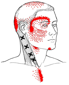 SCM Muscle Pain Areas