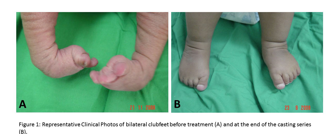 Clubfoot דו-צדדי לפני ואחרי הטיפול