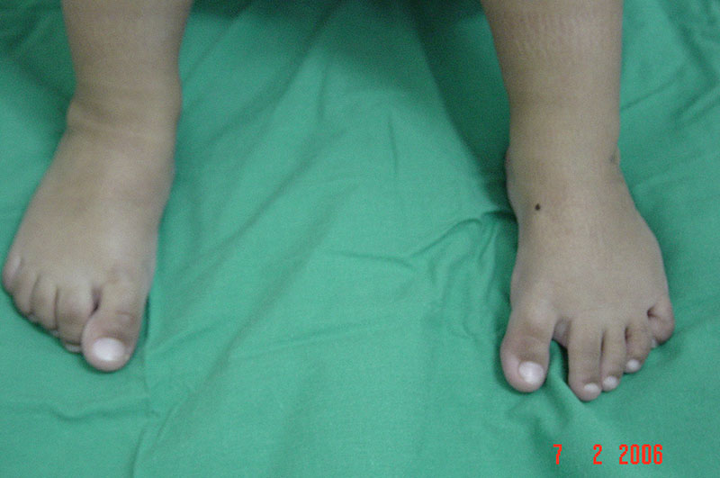 כפות רגליים אחרי טיפול ב-Clubfoot