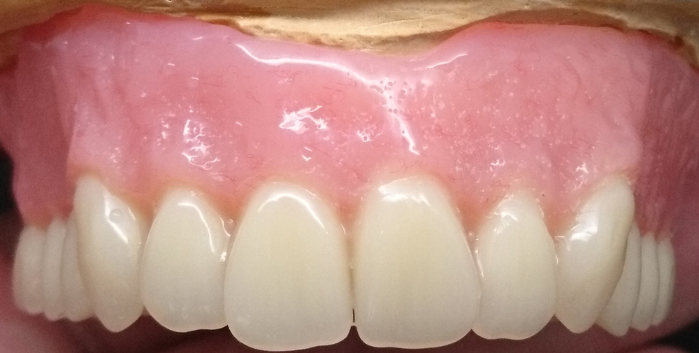 Private dentures made at The Denture Shop